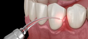Gum Disease Laser Therapy in Santa Ana CA