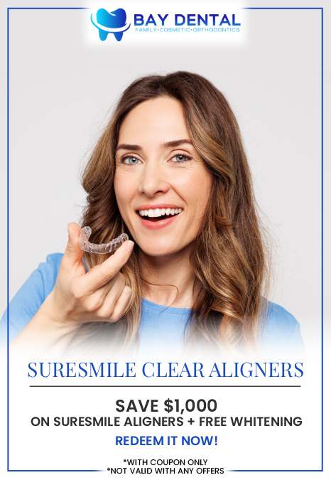 Clear Aligners Offer at Bay Dental in Santa Ana CA
