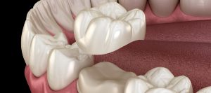 Same Day Crowns in Santa Ana CA